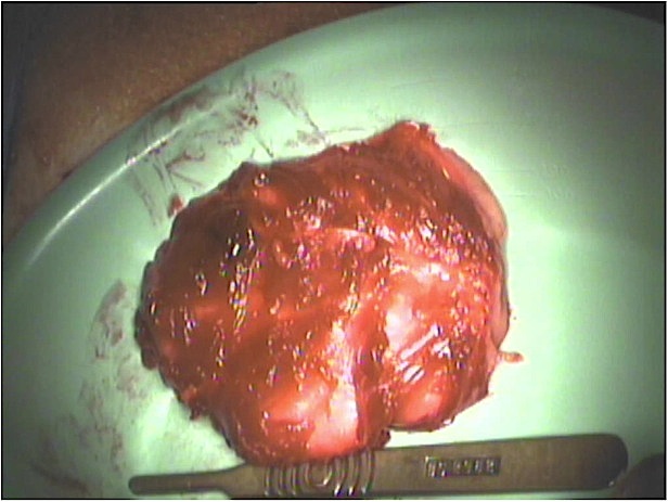 Lipoma Clinical Photo 2